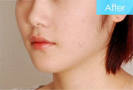 돌출입 교정 after