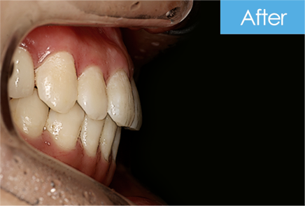 반대교합 교정 after