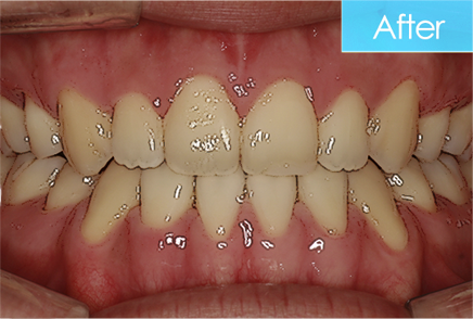 개방교합 교정 after