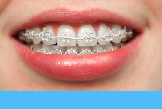 심미적 메탈브라켓