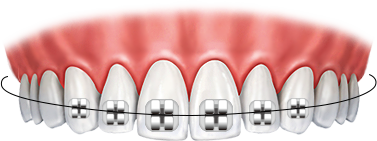 수술없이 진행되는 치아교정!