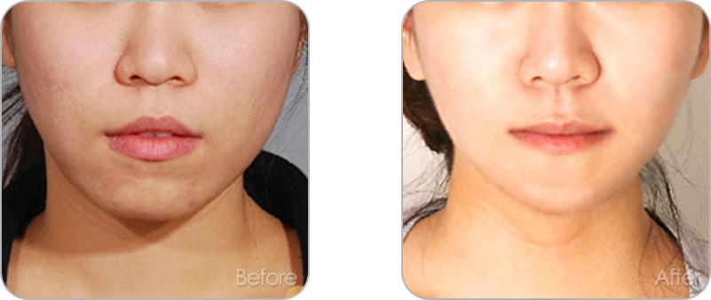 수술없이 진행되는 치아교정 교정 전