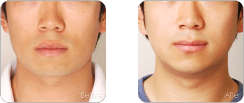 수술없이 진행되는 치아교정 교정 전