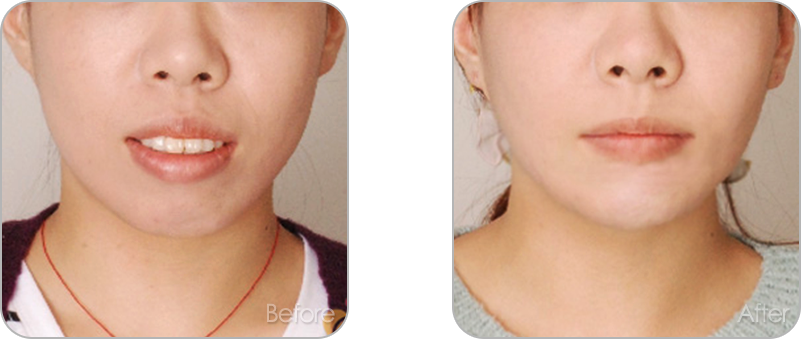 수술없이 진행되는 치아교정 교정 전