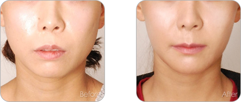 수술없이 진행되는 치아교정 교정 전