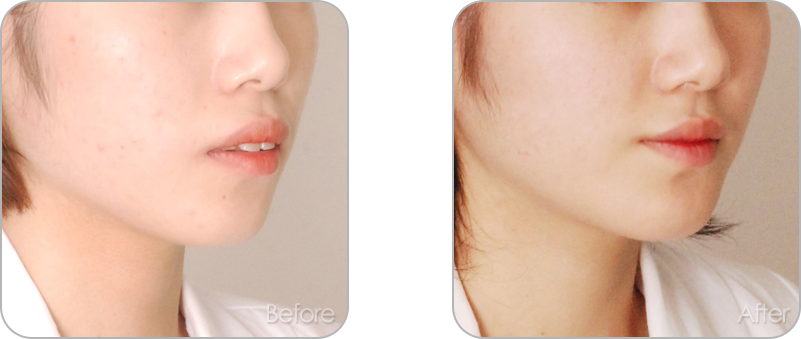 수술없이 진행되는 치아교정 교정 전