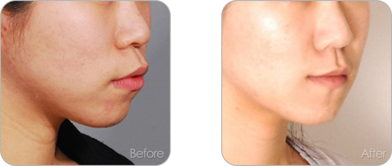 수술없이 진행되는 치아교정 교정 전