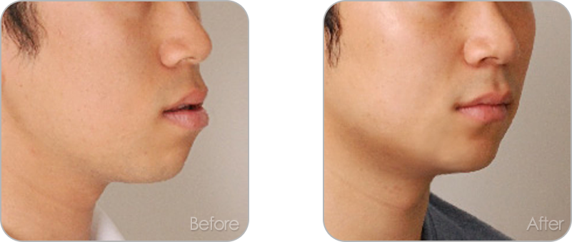 수술없이 진행되는 치아교정 교정 전