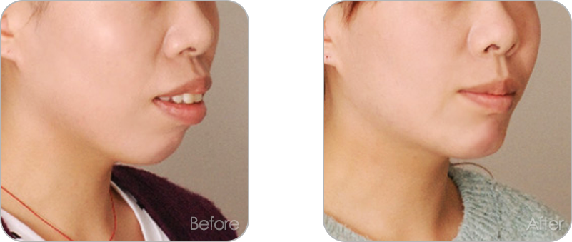 수술없이 진행되는 치아교정 교정 전