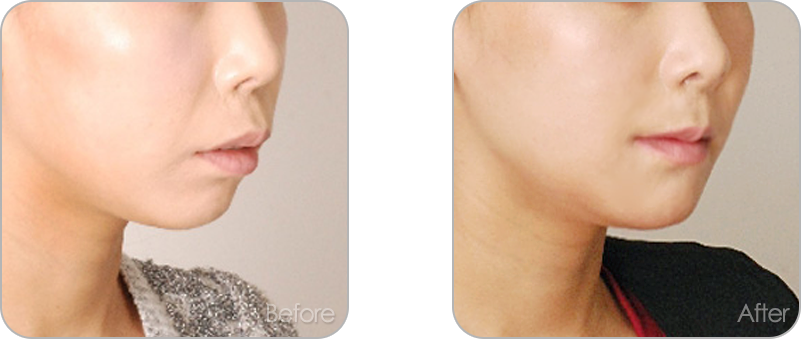 수술없이 진행되는 치아교정 교정 전