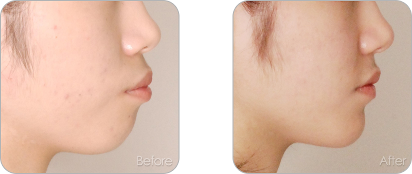 수술없이 진행되는 치아교정 교정 전