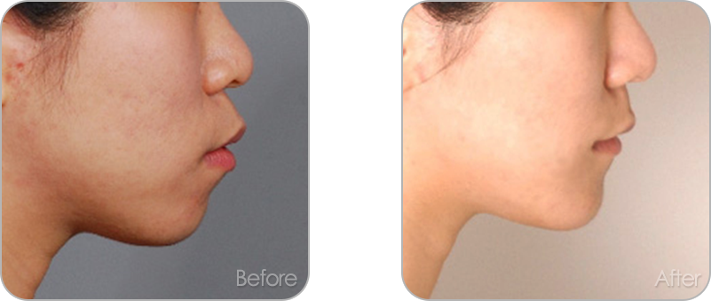 수술없이 진행되는 치아교정 교정 전