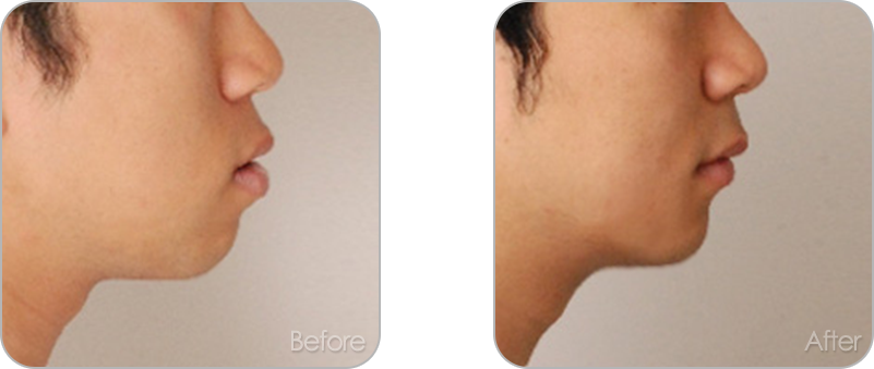 수술없이 진행되는 치아교정 교정 전