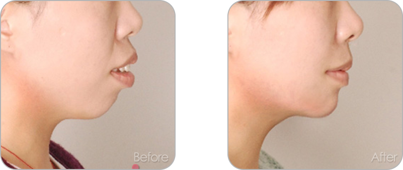 수술없이 진행되는 치아교정 교정 전