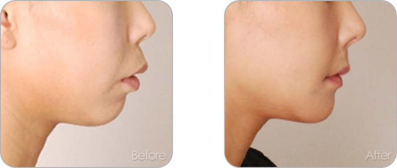 수술없이 진행되는 치아교정 교정 전