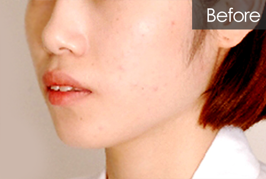 돌출입 교정 before