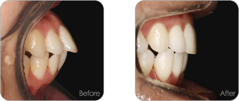 돌출입 교정 전