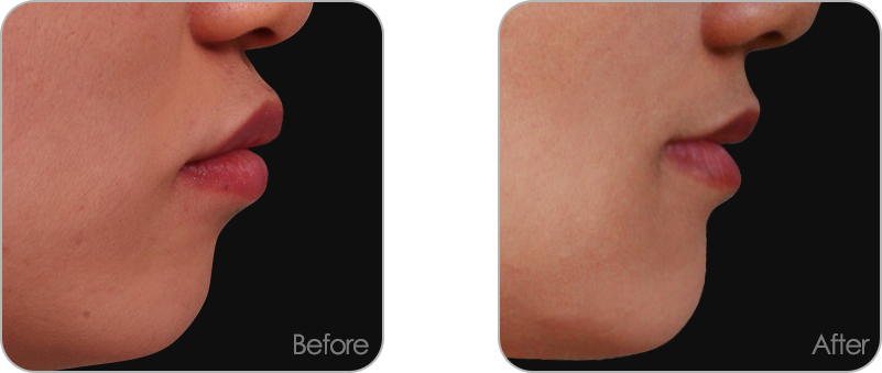 돌출입 교정 전