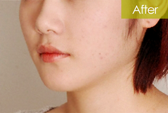 돌출입 교정 after