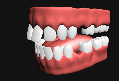돌출입 교정 시뮬레이션