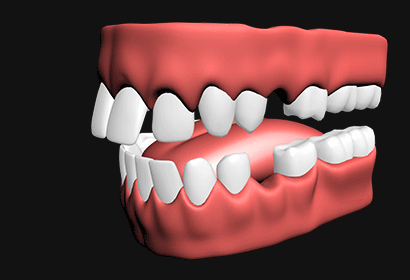 돌출입 교정 시뮬레이션