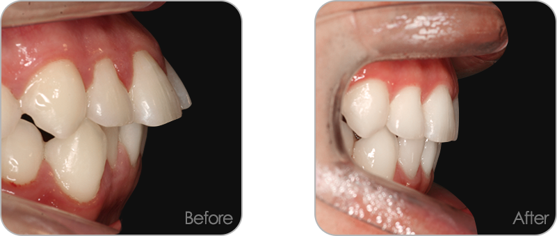 돌출입 교정 전