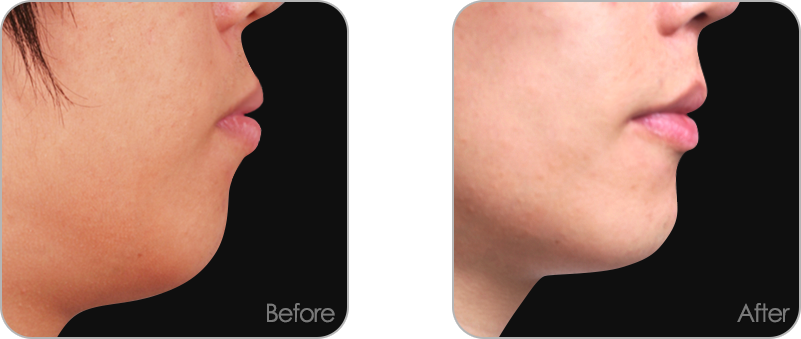 돌출입 교정 전