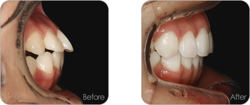 돌출입 교정 전