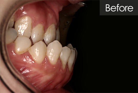 반대교합 교정 before