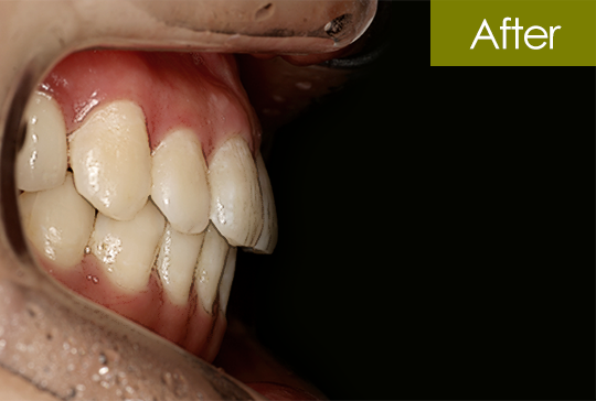 반대교합 교정 after