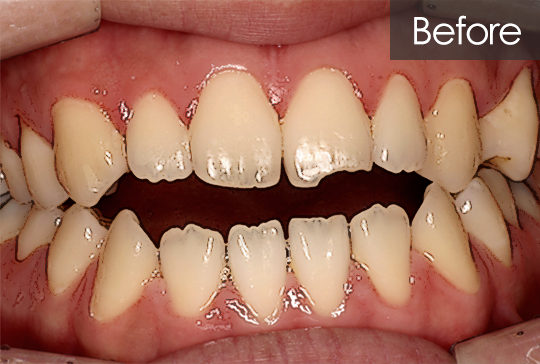 개방교합 교정 before