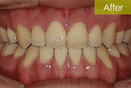 개방교합 교정 after