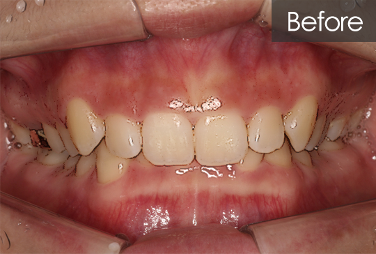 과개교합 교정 before