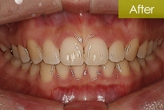 과개교합 교정 after