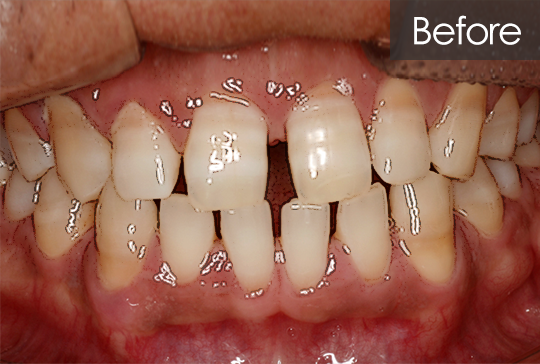 틈새 교정 before