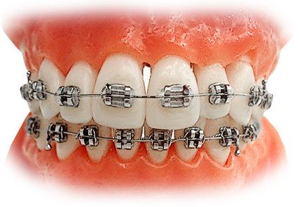 금속(메탈)교정