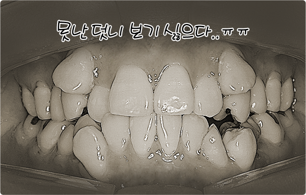 못난 덧니 보기 싫으다.