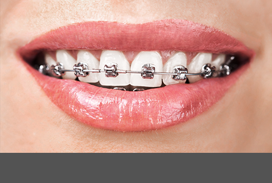 비심미적 메탈브라켓