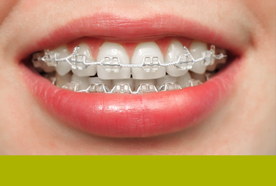 심미적 메탈브라켓