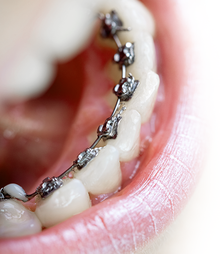 화이트E치과 교정치료 과정