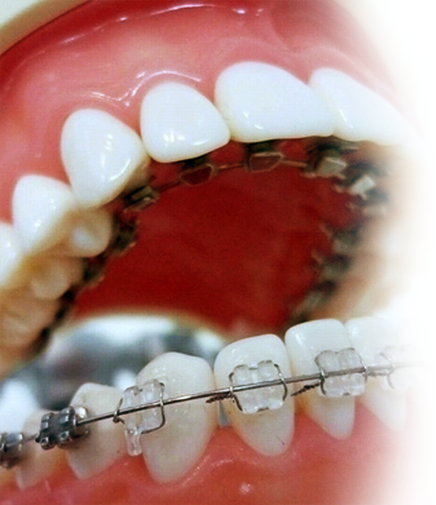 화이트E치과 교정치료 과정