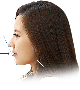 기간을 단축시킨 돌출입 해결 치아교정!