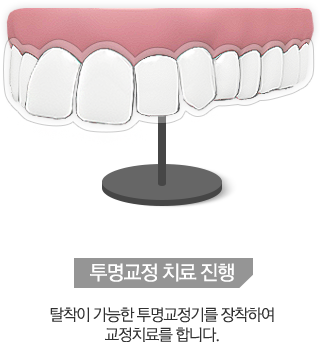 투명교정 치료 진행 - 탈착이 가능한 투명교정기를 장착하여 교정치료를 합니다.