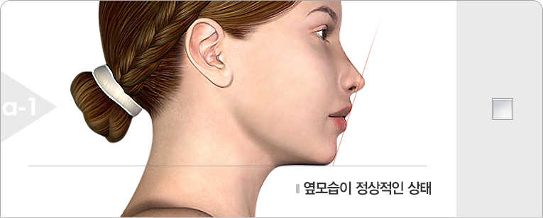 옆모습이 정상적인 상태