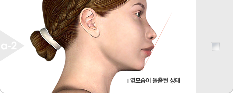 옆모습이 돌출된 상태