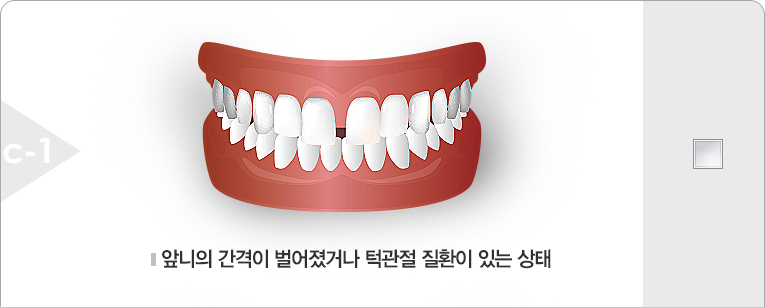 앞니의 간격이 벌어졌거나 턱관절 질환이 있는 상태