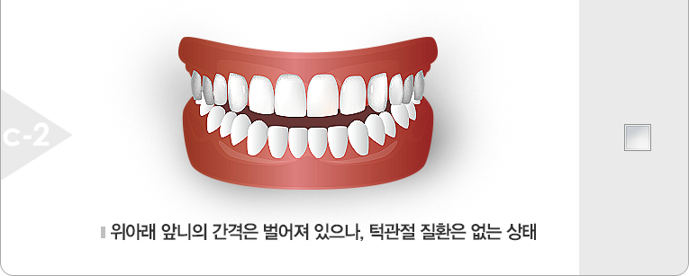 위아래 앞니의 간격은 벌어져 있으나, 턱관절 질환은 없는 상태