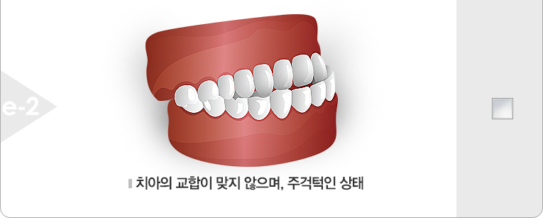 치아의 교합이 맞지 않으며, 주걱턱인 상태