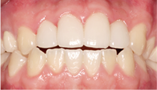 앞니가 삐뚤삐뚤하거나 손상된 경우 after