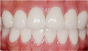 앞니 사이가 벌어져 있는 경우 after